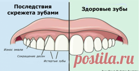 Если вы скрипите зубами по ночам, вот что это значит! - Женский Журнал Мы все так или иначе сталкиваемся с бруксизмом, или скрежетом зубов — это распространенное последствие стресса и беспокойства. Такое расстройство вызывает неприятные ощущения и неприязнь к партнеру, у которого имеются такие проблемы. Если вы вчера не пили алкоголь, тогда почему у вас ощущение похмелья утром? Это еще один из вопросов, на который человек не может …
