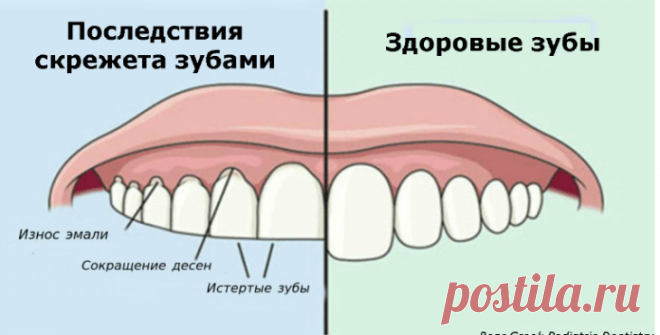 Если вы скрипите зубами по ночам, вот что это значит! - Советы и Рецепты Мы все так или иначе сталкиваемся с бруксизмом, или скрежетом зубов — это распространенное последствие стресса и беспокойства. Такое расстройство вызывает неприятные ощущения и неприязнь к партнеру, у которого имеются такие проблемы. Если вы вчера не пили алкоголь, тогда почему у вас ощущение похмелья утром? Это еще один из вопросов, на который человек не может …