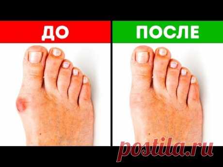 5 Эффективных Способов Избавиться от Косточки на Большом Пальце