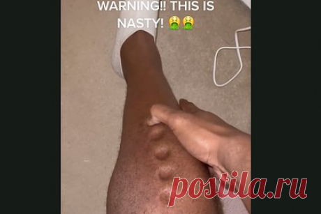 Мужчина с опасной инфекцией пожаловался на пластилиновую кожу. 31-летний спортсмен Лоуренс Окойе рассказал о своей редкой и смертельно-опасной болезни. В опубликованном в соцсети видео он показал, что его тело стало, как пластилин. Виной тому оказалась подкожная флегмона. Болезнь, если ее не вылечить вовремя, приводит к сепсису и даже смерти.