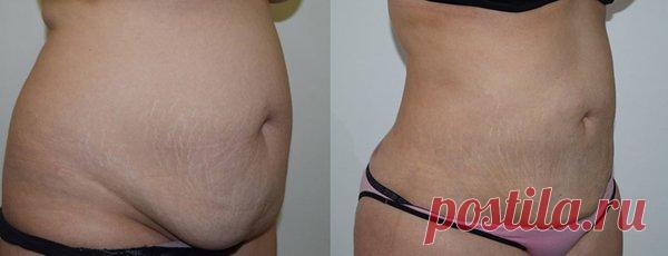 Отличное средство для похудения в домашних в условиях, жир с живота исчез за полмесяца, а вес стал меньше на 10 кг | Худеем вместе | Яндекс Дзен