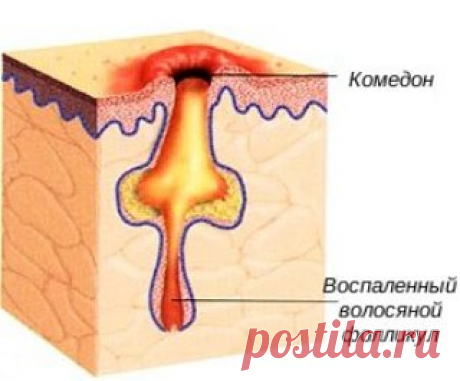 Удаляем комедоны и загрязнения обычным яйцом