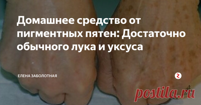 Домашнее средство от пигментных пятен: Достаточно обычного лука и уксуса Пигментные пятна - это почти неизбежный спутник старения. Как бы вы не старались предотвратить их появление, они все равно возникнут на открытых участках кожи, которые периодически попадают под прямые солнечные лучи. Еще одна серьезная проблема с пигментными пятнами - это сложность в их выведении.