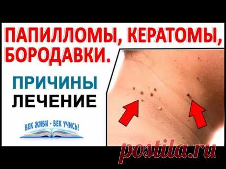 Папилломы, кератомы, бородавки. Причины образования и Лечение! Здоровая КОЖА!
