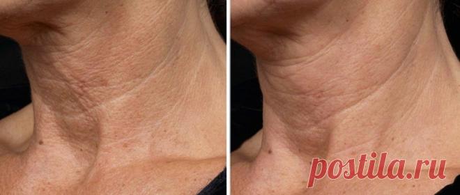 Дряблая кожа