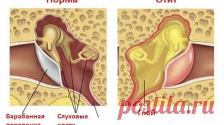Отит — народные средства лечения — Умный совет