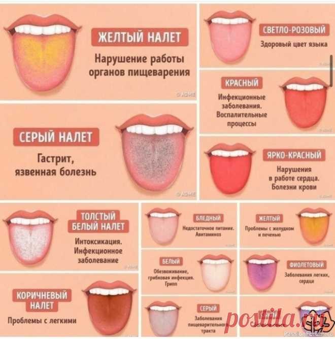 О чем может рассказать цвет языка и налет на нем Язык является одним из наиболее важных индикаторов состояния здоровья всего организма. У здорового человека язык бледно-розового цвета, на нем хорошо различимы сосочки и продольная складка. Некоторое количество белесоватого налета не служит причиной для беспокойства, если он легко...