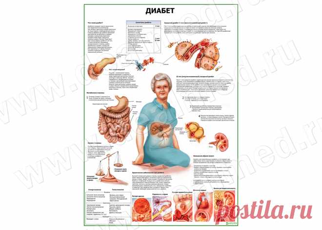 Диабет плакат глянцевый/ламинированный А1/А2 › купить, цена в Москве, оптом и в розницу