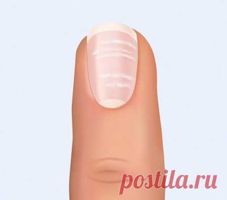 Вертикальные бороздки или белые пятна на ногтях, как правило, безвредны. Если ногти изогнуты вверх и похожи на ложки, это может быть связано с железодефицитной анемией, гемохроматозом (избыточным поглощением железа), заболеванием сердца или гипотиреозом.