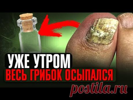 Даже за 8 мин. Грибок осыпается! Запомни 2 способа как избавиться от грибка ногтей (важно)