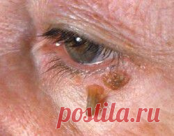 Как лечатся бородавки на лице? Традиционные и народные способы