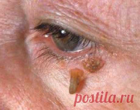 Как лечатся бородавки на лице? Традиционные и народные способы