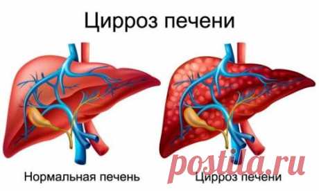 Рецепты лечения цирроза печени народными средствами