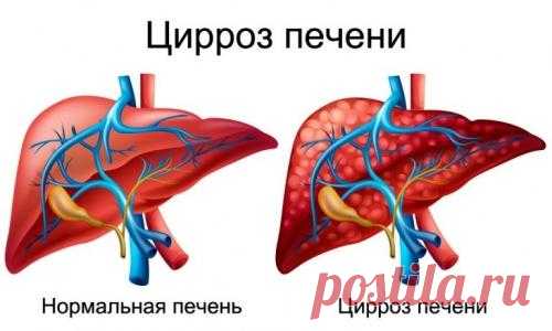 Рецепты лечения цирроза печени народными средствами