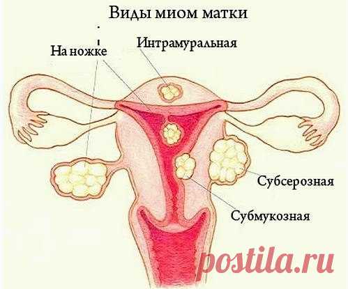 Миома

