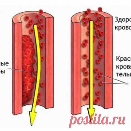 Профилактика образования тромбов. Это касается каждого!