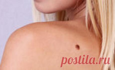 Как легко удалить родинки, бородавки, папилломы естественным путем