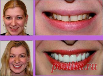 Perfect Smile Veneer