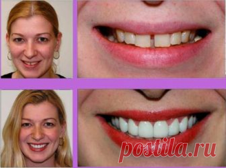 Perfect Smile Veneer