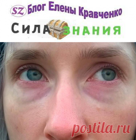 Темные круги под глазами — как избавиться в домашних условиях