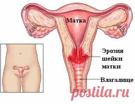 ЛЕЧЕНИЕ ЭРОЗИИ ШЕЙКИ МАТКИ.