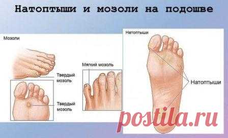 Натоптыши на ступнях: лечение, быстрое избавление в домашних условиях Натоптыши на ногах - отчего возникают, каковы причины появления натоптышей со стержнем, как бороться с проблемой народными средствами в домашних условиях.