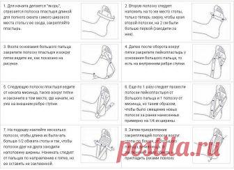 Лечение пяточной шпоры в домашних условиях, народными средствами