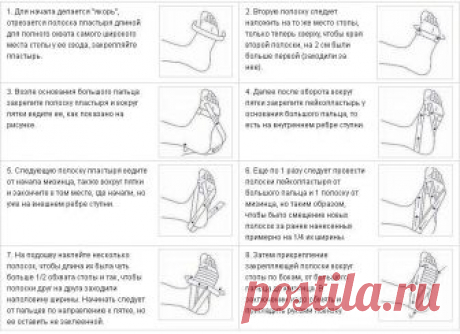 Лечение пяточной шпоры в домашних условиях, народными средствами