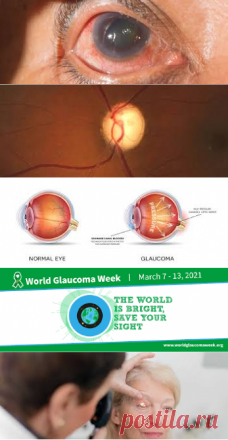 Glaucoma – Google Поиск
