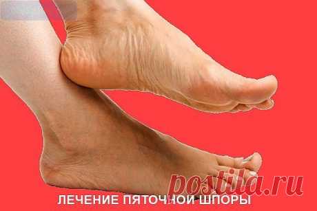 Народные рецепты пяточные шпоры