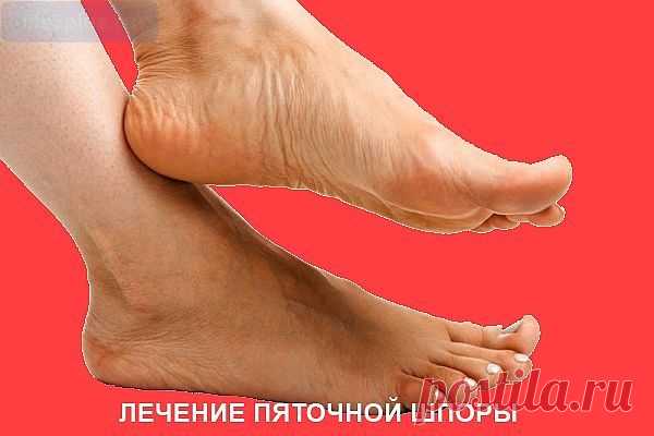 Народные рецепты пяточные шпоры