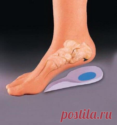 Пяточная шпора. Лечение народными средствами.