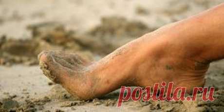 (+1) тема - Признаки артрита стопы | Первая помощь
Артрит стопы – заболевание, имеющее весьма неприятные симптомы. Оно характеризуется поражением сустава. Ноги и стопы в частности являются основным гарантом подвижности человека. Сильные боли, воспаление, деформация суставов приводят к ограничению подвижности, резко снижают трудоспособность и значительно сказываются на возможности жить полноценной жизнью. Определить правильное лечение непросто. В зависимости от природы поражения суставов стоп, а