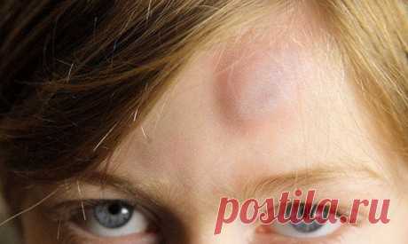 КАК ЛЕЧИТЬ УШИБЫ. КАК БЫСТРО ИЗБАВИТЬСЯ ОТ ГЕМАТОМЫ И УШИБА НАРОДНЫМИ СРЕДСТВАМИ... | Познавательный сайт ,,1000 мелочей&quot;