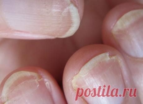 Женщина увидела странные полосы на ногтях. Кто бы мог подумать, что ЭТО спасет ей жизнь!