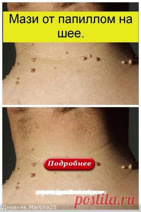 МАЗИ ОТ ПАПИЛЛОМ НА ШЕЕ