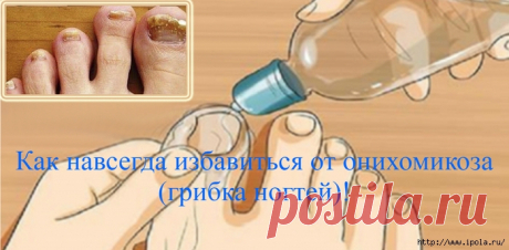 Как навсегда избавиться от онихомикоза (грибка ногтей)!