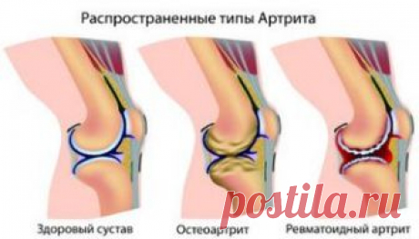Артрит: Советы и Народные методы лечения артрита. Рецепты народной медицины