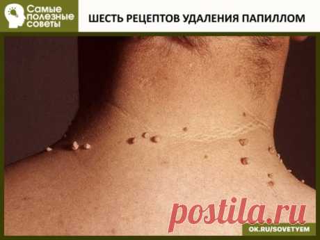 ШЕСТЬ РЕЦЕПТОВ УДАЛЕНИЯ ПАПИЛЛОМ
Первый рецепт.
Для избавления от папиллом в домашних условиях рекомендуется использовать порошок, приготовленный из хорошо просушенных семян расторопши, благотворно действующего на организм в целом. Данный порошок следует принимать по одной чайной ложечке трижды – четырежды в день, запивая его водой. При этом до приёма пищи с момента приёма должно пройти не менее двух часов.
Второй рецепт.
Одним из самых эффективных популярных наружных домашних средств против