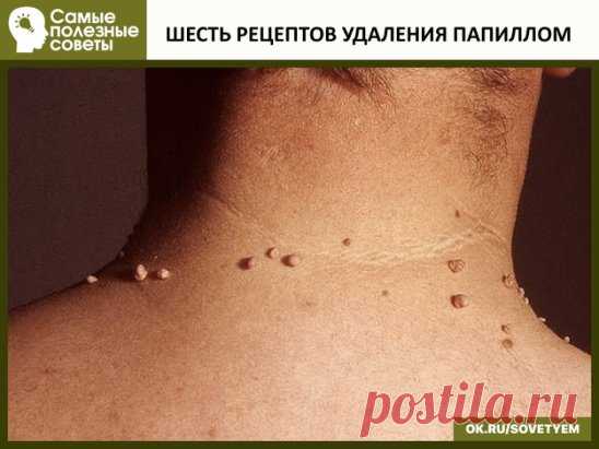 ШЕСТЬ РЕЦЕПТОВ УДАЛЕНИЯ ПАПИЛЛОМ
Первый рецепт.
Для избавления от папиллом в домашних условиях рекомендуется использовать порошок, приготовленный из хорошо просушенных семян расторопши, благотворно действующего на организм в целом. Данный порошок следует принимать по одной чайной ложечке трижды – четырежды в день, запивая его водой. При этом до приёма пищи с момента приёма должно пройти не менее двух часов.
Второй рецепт.
Одним из самых эффективных популярных наружных домашних средств против