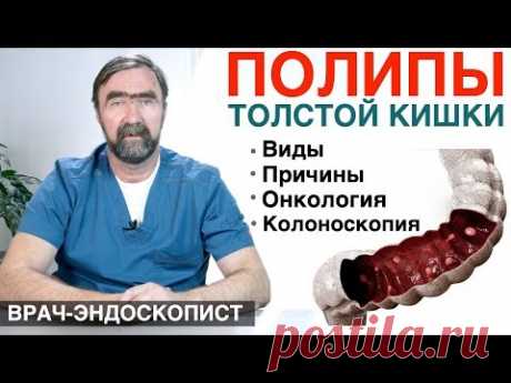 ПОЛИПЫ ТОЛСТОЙ КИШКИ - причины появления полипов, симптомы полипов, диагностика полипов в кишечнике