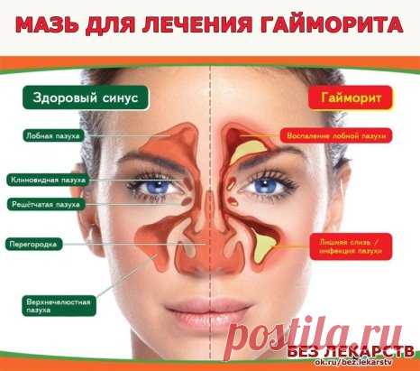 Готовим мазь для лечения гайморита.
* Берем в равных пропорциях мед, растительное масло (лучше подсолнечное) и водку.
* Измельчаем блендером хозяйственное мыло и репчатый лук (в таких же пропорциях, как и предыдущие компоненты).
* Тщательно перемешиваем и нагреваем на водяной бане.
* Однородную массу остужаем до комнатной температуры, наносим на на ватную палочку и вводим мазь в нос на 20 мин. 3-4 раза в день.
Не забываем укреплять иммунитет витаминами, делать травяные инг...