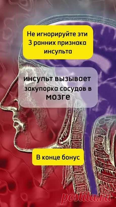 Ранние признаки инсульта