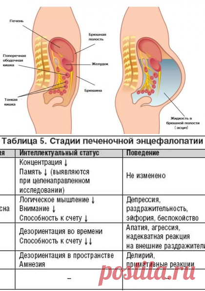 Асцит брюшной полости: лечение, причины, симптомы, асцит при онкологии | Азбука здоровья