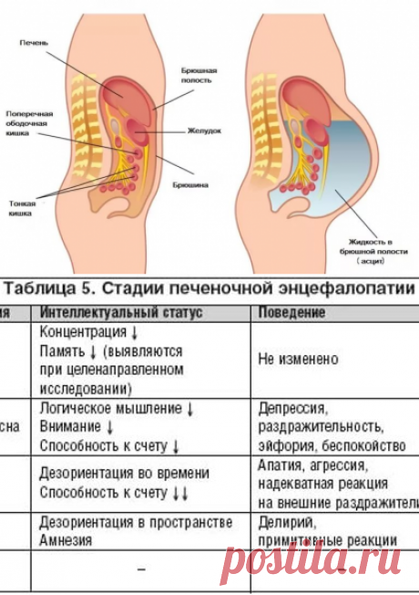 Асцит брюшной полости: лечение, причины, симптомы, асцит при онкологии | Азбука здоровья
