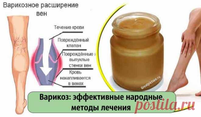 Варикоз: эффективные народные методы лечения 
 Варикоз: эффективные народные методы лечения.
Для лечения варикозного расширения вен народными средствами могут применяться мази, компрессы, аппликации и смеси для наружного применения, а также наст…