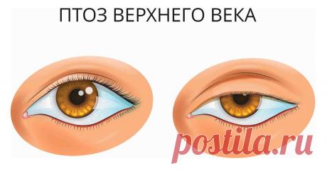 Опущение верхнего века  (код МКБ-10; код МКБ-11): описание, причины, симптомы, как лечить | Клиника лечения боли: врачи онлайн