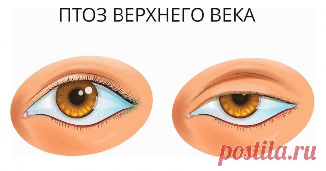 Опущение верхнего века  (код МКБ-10; код МКБ-11): описание, причины, симптомы, как лечить | Клиника лечения боли: врачи онлайн