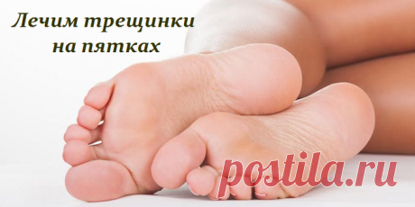 Лечим трещинки на пятках