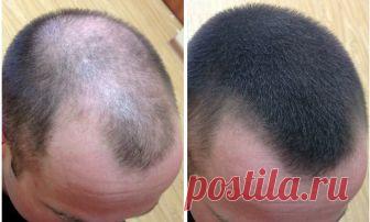 Как вырастить волосы на лысине: причины, рецепты Лысина у мужчины: как можно восстановить волосы Причины облысения Как правило, мужчины начинают лысеть с макушки и передней части черепа. Многим женщинам лысый мужчина кажется более сексуальным и привлекательным. Но большая часть сильного пола при появлении подобной проблемы обеспокоена потерей волос. Зачастую это прив